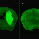 Especialistas del CONICET lograron frenar un tipo de cáncer cerebral con una novedosa estrategia terapéutica