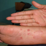 Rosario: alarma por la gran cantidad de casos de sífilis